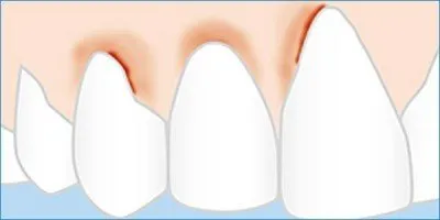 Ce să faci dacă gingiile se îndepărtează de dinți