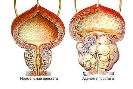 Ce metode populare sunt folosite în lupta împotriva adenomului de prostată