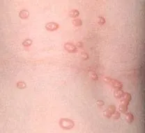 contagiosum