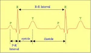 Ce este indicat pe banda ECG în timpul infarctului miocardic în funcție de clasificarea acestuia