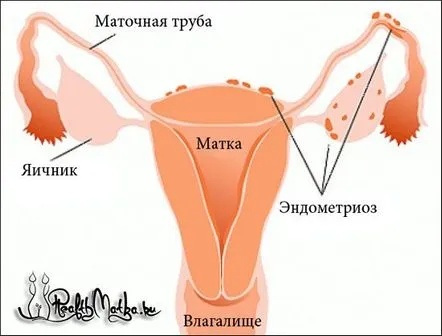 Endometrioza corpului uterin. Semne, interne și difuze