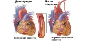 Manevrarea vaselor inimii și a vaselor extremităților inferioare, care este costul tratamentului și recenzii