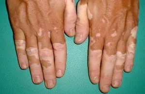 vitiligo