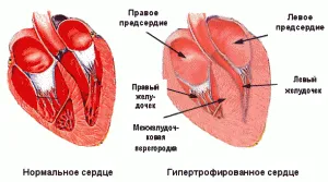 Hipertrofia ventriculului drept pe ECG, cum să o detectăm