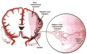 Simptomele ischemiei cerebrale și tratamentul bolii