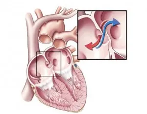 Suflu în inima copilului, cauze și metode de diagnostic