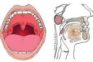Semne ale amigdalitei cronice și codul său ICD 10