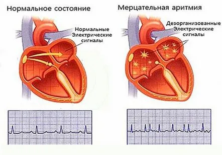 Aritmie, tratament cu remedii populare. Rețete de la oameni pentru tratament și prevenire.