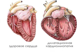 Cardiomiopatia dilatată cauzele și simptomele bolii