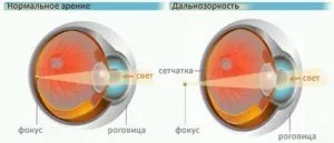 Indiferent de distanță, tratamentul hipermetropiei