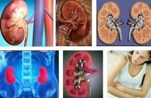 Glomerulonefrita 5 metode de tratament cu remedii populare