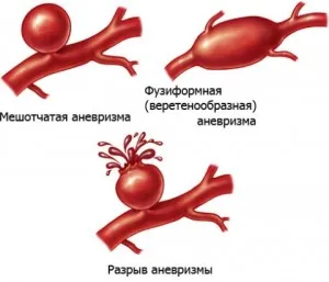 arterial