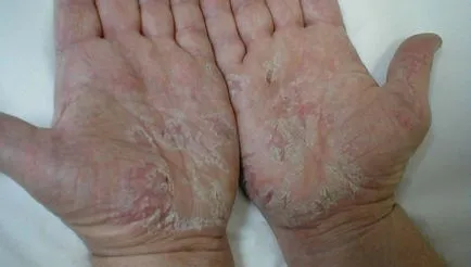 Dermatitis a kezét a tenyér és az ujjak kezelés okozza, tünetei, mindent allergia