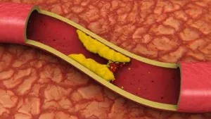 Dislipidemia, ce fel de boală este și cum să o tratăm corect