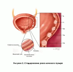 cancerului