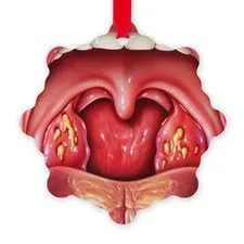 Cauzele și tratamentul amigdalitei la adulți
