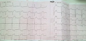 Simptomele infarctului miocardic și consecințele bolii