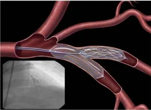 stenting