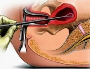 Ce trebuie să știți despre răzuirea cavității uterine