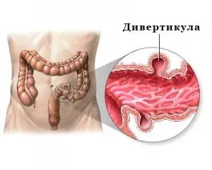 7 moduri eficiente de a trata diverticuloza