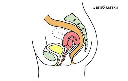 Cauzele prolapsului uterin la femei după naștere