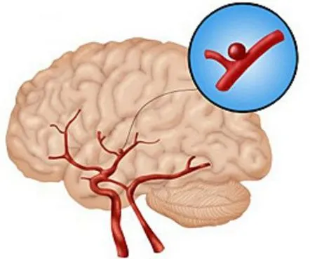 Anevrism cerebral, boli vasculare. Cum să tratezi