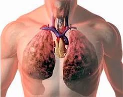 pulmonare