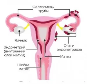 Endometrioza la femei