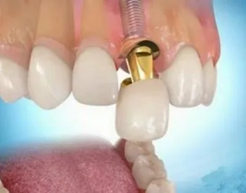 Cât costă un implant dentar?