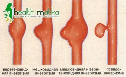 Anevrismul cerebral și cum să îl preveniți