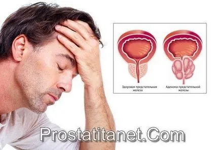 Caracteristicile adenomului de prostată, simptomele sale și metodele de tratament