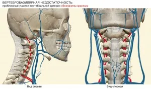 Insuficiența vertebro-bazilară, ce este și cum se tratează boala