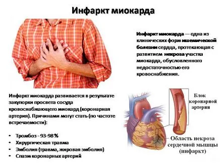 Forme de infarct miocardic, ce sunt și cum se manifestă