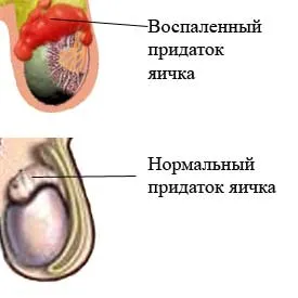 Cauzele epididimitei și tratamentul cu remedii populare