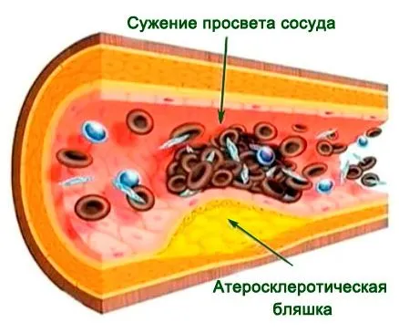 Ateroscleroza este o boală a sistemului cardiovascular