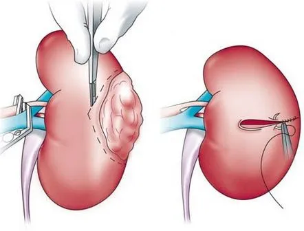 Procedura de nefrectomie (eliminarea unui rinichi) și consecințe