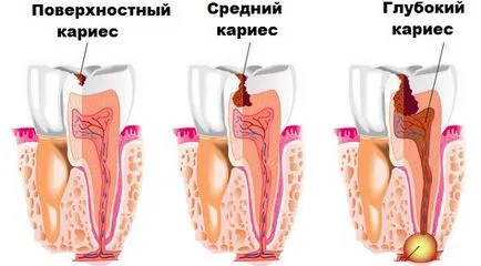 A fogszuvasodás Diagnostics - klinika és módszerei differenciáldiagnózisa fogszuvasodás