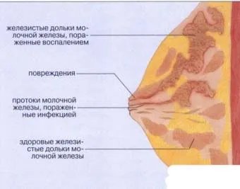 Ние лекуваме мастит