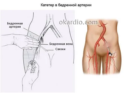 contraindicații coronariene contraindicații coronariene