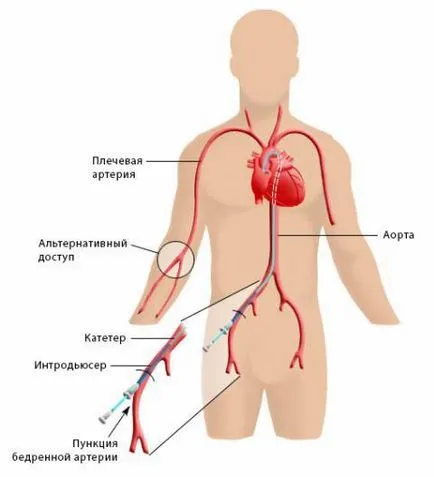 contraindicații coronariene