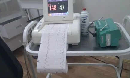 Cum să descifreze rezultatul CTG