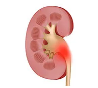 Rinichi pelvis ce este