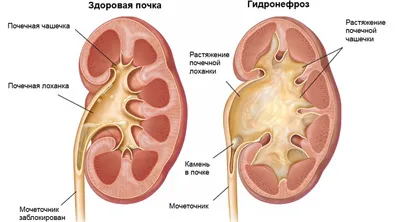 Rinichi pelvis ce este