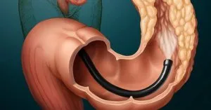 Diagnosticul a intestinului subtire