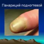 Tratamentul abces pe deget de la picior
