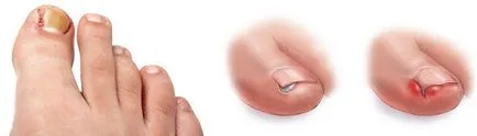 Tratamentul abces pe deget de la picior Tratamentul abces pe deget de la picior