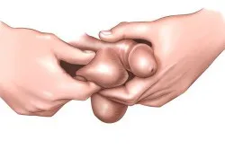 testicul Umflarea că testicul Umflarea că