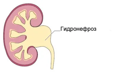 Rinichi pelvis ce este