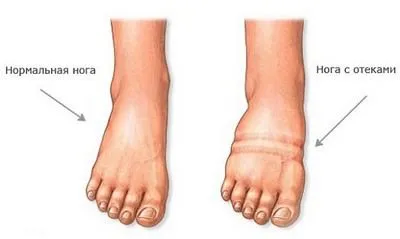 Ce este umflarea în timpul sarcinii