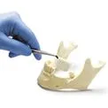 Proteza sau implantare Proteza sau implantare